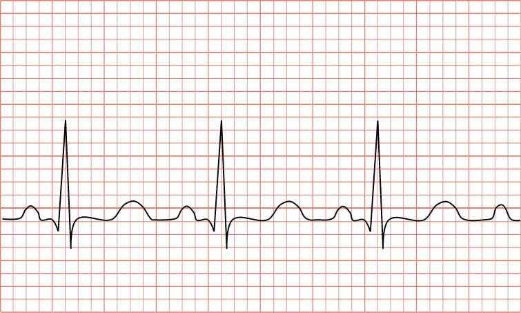 Increased heart rate