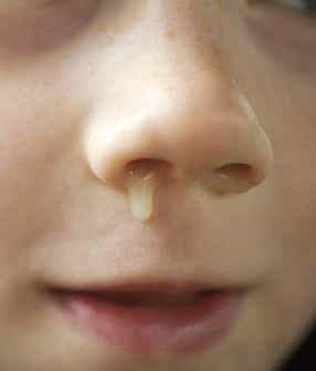 Runny nose